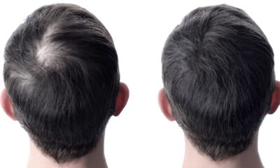 Can I Use Hair Fibres After Hair Transplant