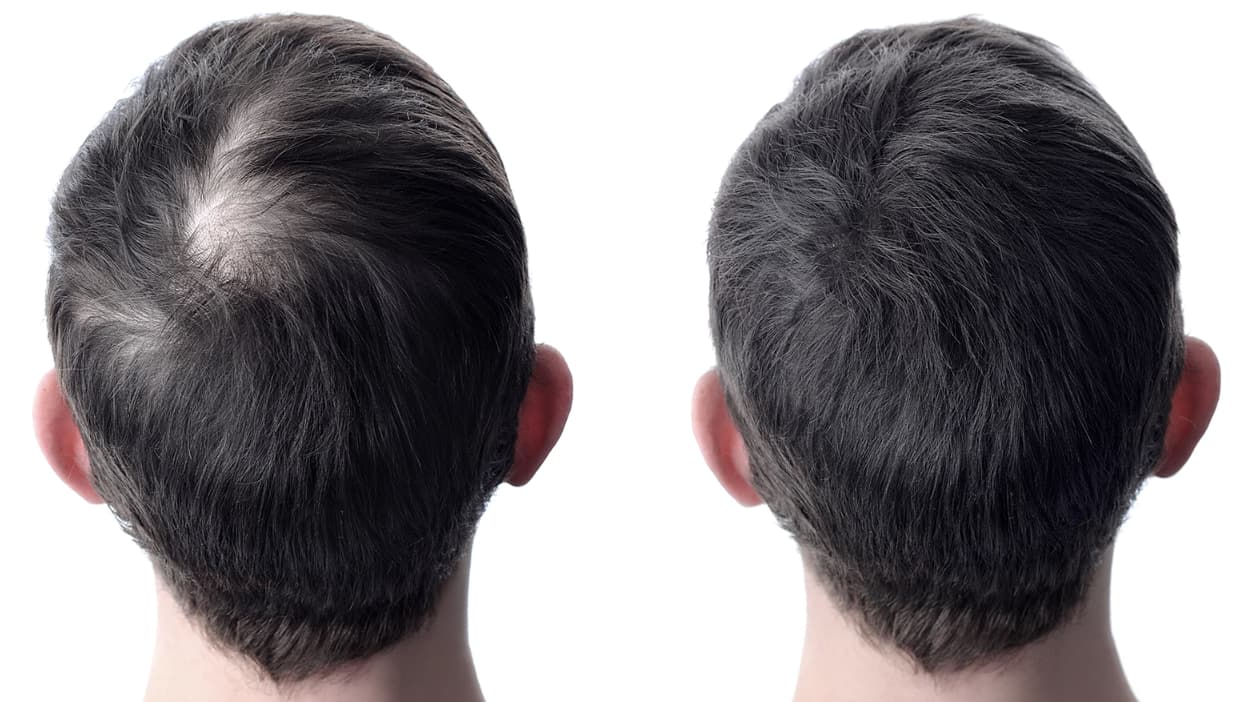 Can I Use Hair Fibres After Hair Transplant