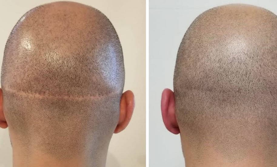 How Long to Avoid Sun After Hair Transplant