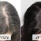 How Much Does PRP For Hair Loss Cost
