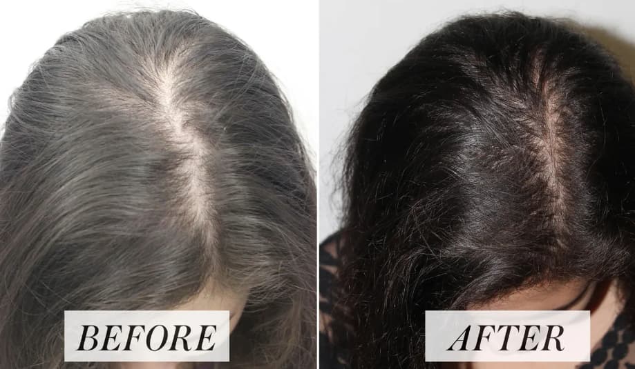 How Much Does PRP For Hair Loss Cost