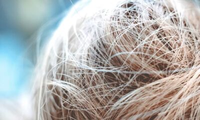 What Causes Hair Loss