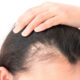 Hair-Loss-Prevention